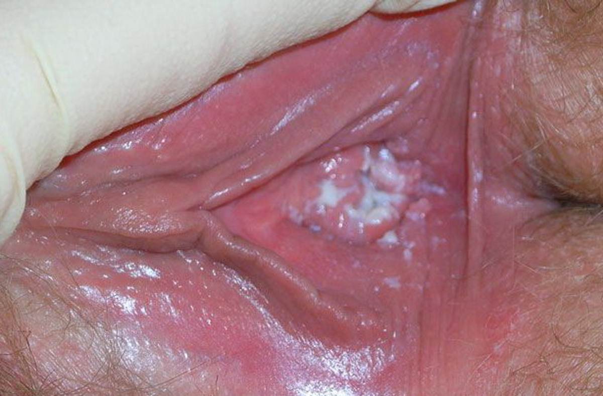 Vaginal Itching Dryness