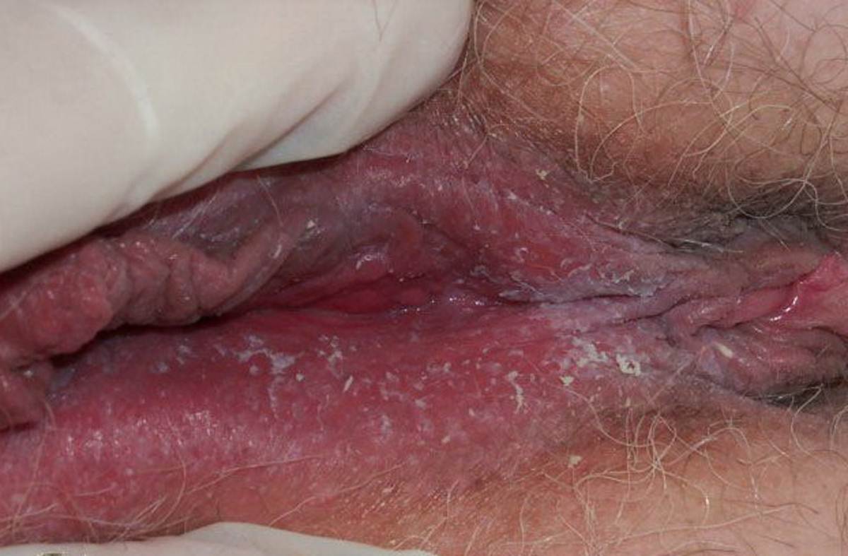 Dry vaginal skin