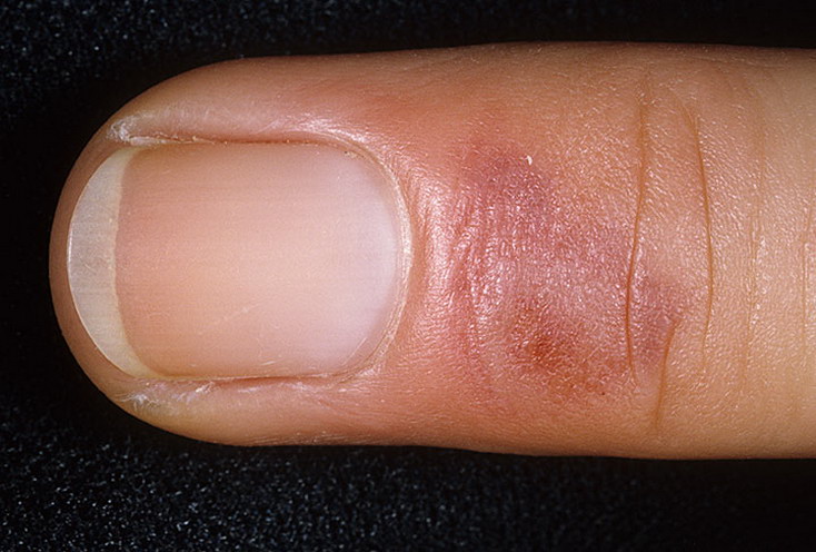 odmrożenia skóry palec