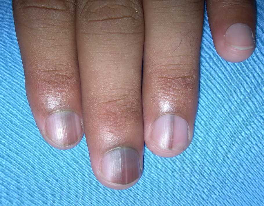 zmiany barwnikowe pod paznokciem