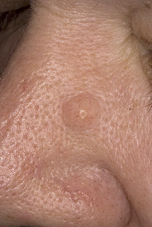 ZDJĘCIA basalioma skóry nosa JAK WYGLĄDA - ( JĄ ) Rak skóry basalioma