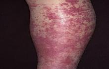 alergiczne zapalenie naczyń krwionośnych na nodze
