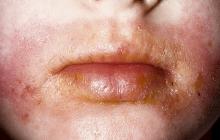 atopowe zapalenie skóry okolice ust