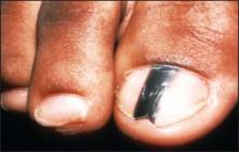 czarne plamki na paznokciach u nog