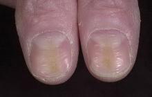 deformacja paznokci