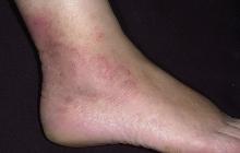 grzybica skóry stopy
