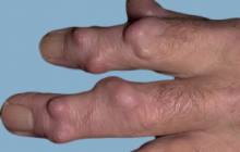 guzki reumatoidalne dłoni 