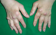 guzki reumatoidalne dłoni zdjęcia
