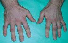 guzki reumatoidalne na palcach