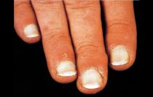 leukonychia paznokci całkowita