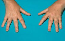 młodzieńcze idiopatyczne zapalenie stawów na dłoniach foto