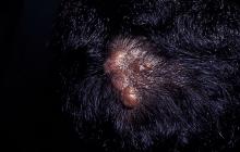 neurofibroma skóra głowy