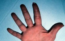 odmrożenia skóry dłoni