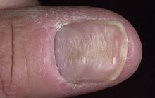 paznokcie choroby bruzdy podłużne