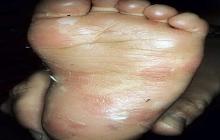 Pęcherzowe oddzielanie się naskórka stopa