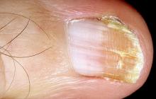 poprzeczne bruzdy na paznokciach u nóg