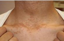 syringoma skin disease