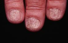 trachyonychia nails