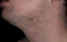 Zapalenie mieszków włosowych brody