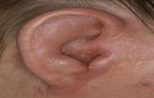zapalenie ucha zewnętrznego objawy u dorosłych