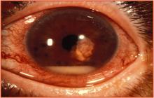 zdjęcia zapalenie wnętrza gałki ocznej 