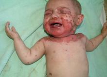 acrodermatitis enteropathica pictures