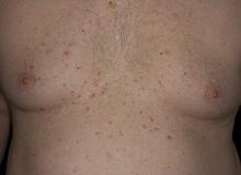 grover's disease skin