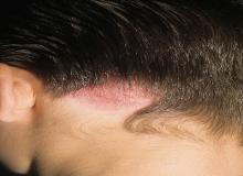 grzybica skóry głowy leczenie domowe