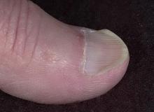 koilonychia paznokcie łyżeczkowate