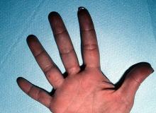 odmrożenia skóry dłoni