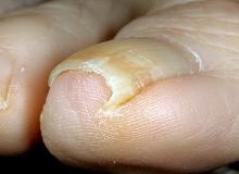 paznokieć wrasta w palec