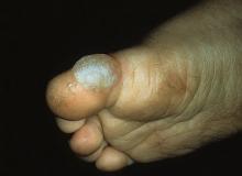 pęcherzowe oddzielanie się naskórka duży palec u nogi