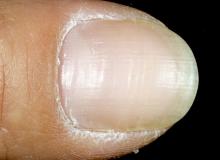 poprzeczne prążki na paznokciach
