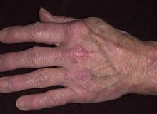 zapalenie skórno-mięśniowe dłoń
