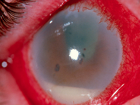zapalenie wnętrza gałki ocznej symptom
