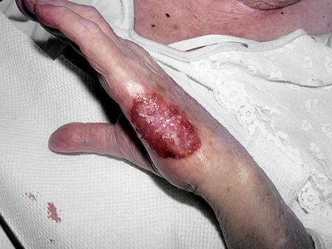 Dłonie choroby skóry CHOROBY SKÓRY ZDJĘCIA OBRAZY WYGLĄD FOTO OBJAWY